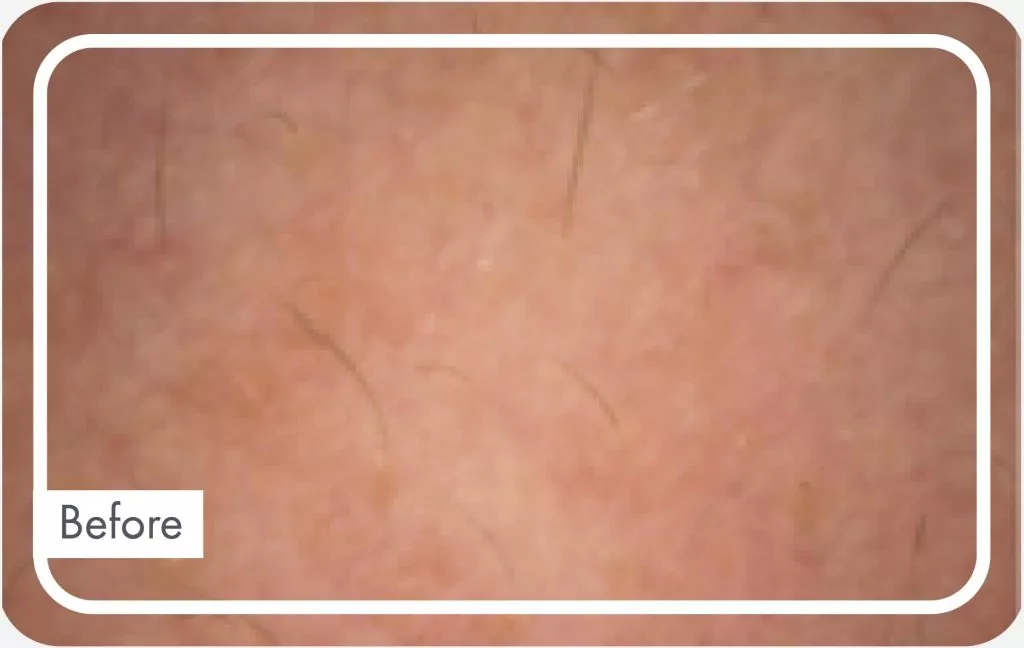 Before skin section