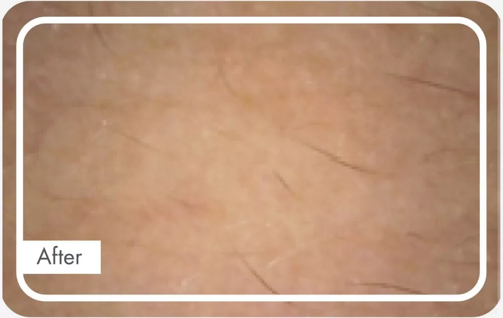 After skin section